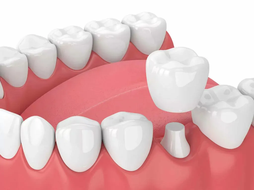 Dental crown placement illustration showing a crown fitted over a prepared tooth