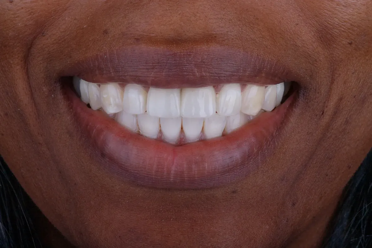 After treatment — Comprehensive smile makeover